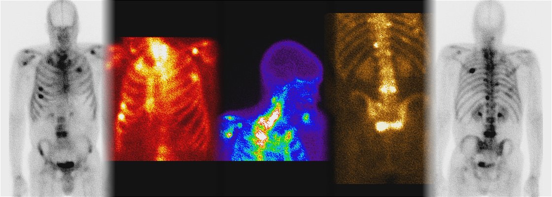 Collage de una cintigrafía ósea pública: cuerpo entero anterior, tórax, cráneo lateral, vista de pie y cuerpo entero posterior, cada una con una paleta de color distinta.